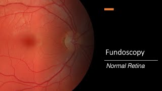 Healthy Retina Fundoscopy [upl. by Loftis]