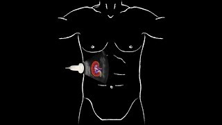 POCUS  Basic Renal Ultrasound [upl. by Eramat141]