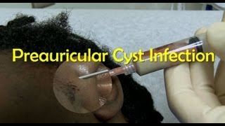 Preauricular Cyst Infection Management [upl. by Ecneitap]