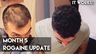 5 Month Rogaine Update Minoxidil  IT WORKS [upl. by Cyprian147]