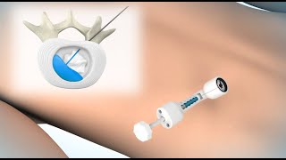 ReGelTec HYDRAFIL™ System [upl. by Faxun]