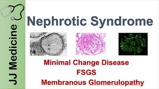 Glomerulonephritis  CRASH Medical Review Series [upl. by Orelle]