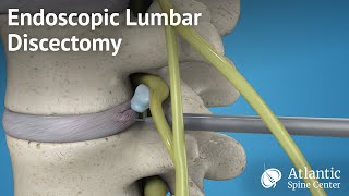 Endoscopic Lumbar Discectomy [upl. by Eciram]