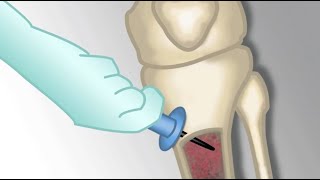 Placement of an Intraosseous Line by MKleinman  OPENPediatrics [upl. by Ojaras]