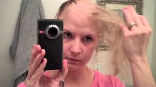 Road to balddom Last 5 days of Chemo hair loss Process [upl. by Avivah]