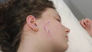 TMJ Dry Needling for TMD  Physical Therapy [upl. by Nalrah]