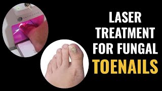 Laser Treatment For Fungal Toenails [upl. by Annais691]