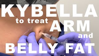 Kybella for Arm and Belly Fat  Dr Paul Ruff  West End Plastic Surgery [upl. by Dowling]