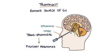 Understanding Acromegaly [upl. by Keenan]