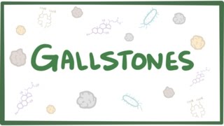 Gallstones cholelithiasis [upl. by Girand]