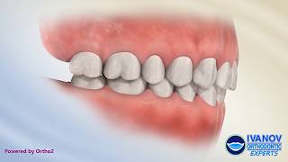 What is Normal Teeth and Bite Occlusion [upl. by Laurita]