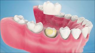 Dental Crown Procedure [upl. by Ledba]