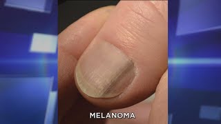 Subungual Melanoma What You Need to Know [upl. by Zetnom]