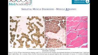 Occipital Neuralgia Exercises Stretches for Occipital Neuralgia [upl. by Ayres]