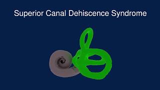 Superior Canal Dehiscence Syndrome SCDS [upl. by Yahsat]