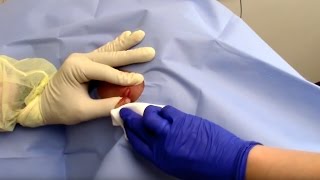 Abscess Drainage Performed by Dermatologist Dr David Myers [upl. by Notgnirrac242]