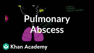 Pulmonary abscess  Respiratory system diseases  NCLEXRN  Khan Academy [upl. by Dabney]