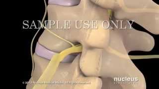 Lesiones de disco lumbar y tratamiento [upl. by Alleyne]