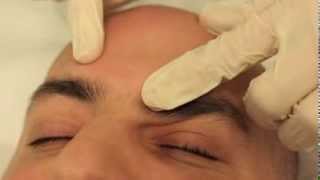 Sebaceous Hyperplasia removal [upl. by Leira]