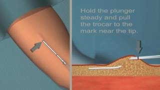 Jadelle insertion and removal Tutorial [upl. by Michelina]