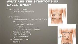 Acute Cholecystitis  Overview signs and symptoms pathophysiology treatment [upl. by Valenba]