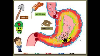 HELICOBACTER PYLORI GASTRITIS [upl. by Sido]