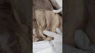 Dissection of Inguinal canal [upl. by Adnerb]