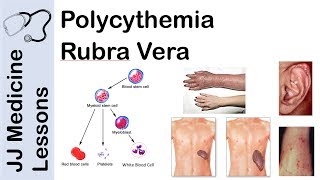 Polycythemia Rubra Vera  Pathophysiology Symptoms Diagnosis and Treatment [upl. by Girardi]