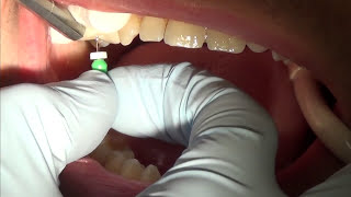 root canal treatment part 1 [upl. by Sorenson]