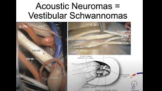 A Rare Brain Tumor Affecting Hearing amp Balance  Acoustic Neuroma [upl. by Ichabod]