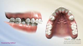 Upper 2nd Bicuspid Extraction  Overjet  Orthodontic Treatment [upl. by Wyatt]