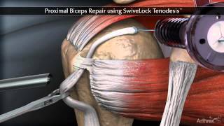 Proximal Biceps Repair using SwiveLock Tenodesis [upl. by Hernardo]