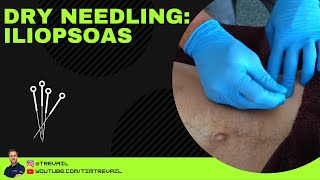 Dry Needling Iliopsoas [upl. by Hpesojnhoj]