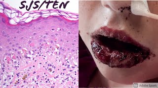 StevensJohnson SyndromeToxic Epidermal Necrolysis SJSTEN Spectrum [upl. by Dominik]