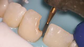 Teeth Bonding  Front tooth filling EXPLAINED [upl. by Ortiz]