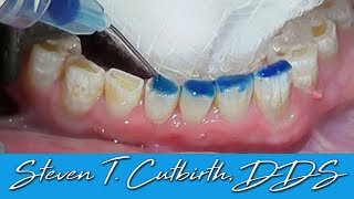 Bonding Worn Anterior Teeth  Dental Minute with Dr Steven T Cutbirth DDS [upl. by Eemyaj]