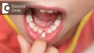 Why do childrens teeth fall out  Dr Raju Srinivas [upl. by Korb]