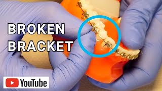 Broken Braces Broken Loose or Sliding Bracket What To Do [upl. by Reace80]