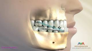 Orthodontic Treatment for Underbite or Crossbite  Carriere Appliance [upl. by Eskill]