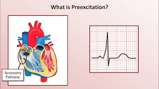 Advanced EKGs  WolffParkinsonWhite WPW Syndrome [upl. by Eladnwahs]