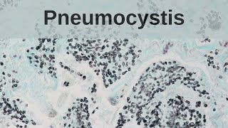 Pneumocystis Pneumonia  Pathology mini tutorial [upl. by Airasor]