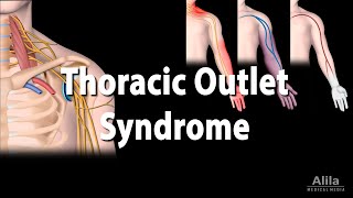 Thoracic Outlet Syndrome TOS Animation [upl. by Flessel]