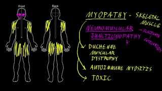 Scleroderma Associated Myopathy  Overview  Johns Hopkins [upl. by Carlene]