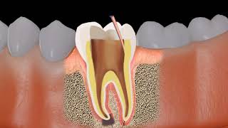 Root canal treatment RCT Procedure animation [upl. by Vanden]