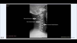 RTG odcinka szyjnego kręgosłupa dyskopatia i zmiany przeciążeniowe [upl. by Winnah]