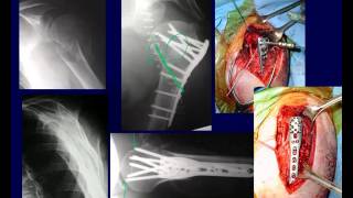 Proximal Humerus Fractures 2 OTA lecture series III u03b [upl. by Jannelle833]