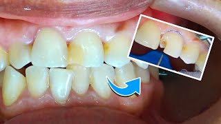 Reconstruccion diente con caries [upl. by Dlarrej]