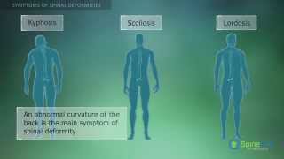 Spinal Deformities Symptoms [upl. by Anilet]