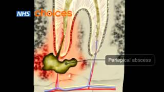 Dental abscess an animation [upl. by Ynez]