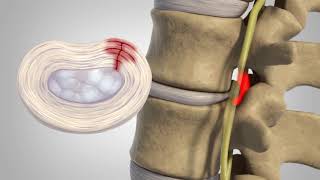 Bulging Discs Causes and Treatment [upl. by Norty]